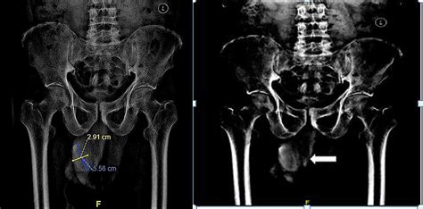 Cureus Phimosis Presenting With Preputial Calculus A Case Report On An Uncommon Presentation