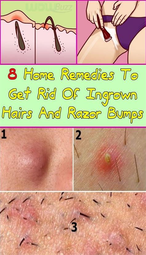 8 Home Remedies To Get Rid Of Ingrown Hairs And Razor Bumps