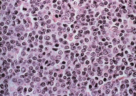 Mantle Cell Lymphoma The Lancet Oncology