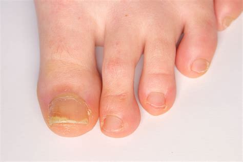 Thickened Nails Waverley Foot Clinic