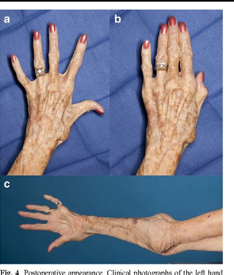 Cubitus Valgus And Tardy Ulnar Nerve Palsy Due To An Intracapsular