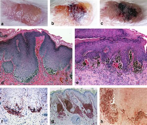 Melanoma Like Lesions In Human Skin Grafts Induced By Cutaneous Download Scientific Diagram