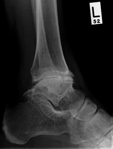 Adult Male Lateral Radiograph Of The Left Ankle Demonstrating Loss Of