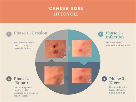 Mouth Ulcer Canker Sore Diagram — Canker Shield