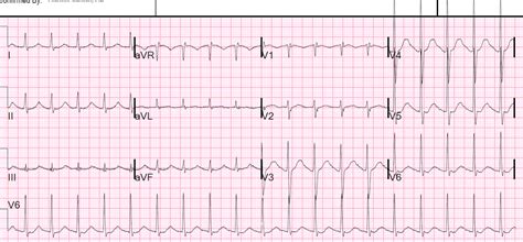 Supraventricular tachycardia (svt) is an abnormally fast heart rhythm arising from improper electrical activity in the upper part of the heart. Dr. Smith's ECG Blog: August 2017