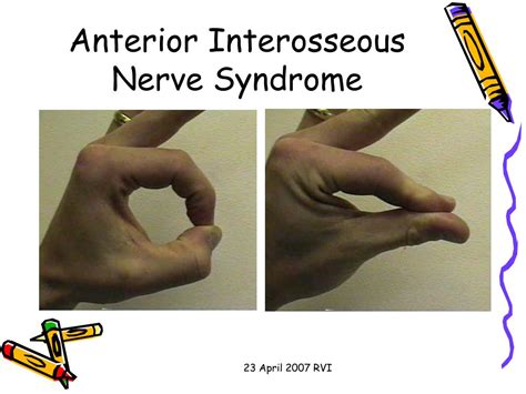 Ppt Median Nerve Compression Syndromes Powerpoint Presentation Free