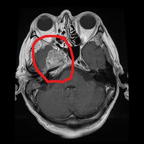 Nasopharyngeal Carcinoma Radiology Case Radiopaediaorg