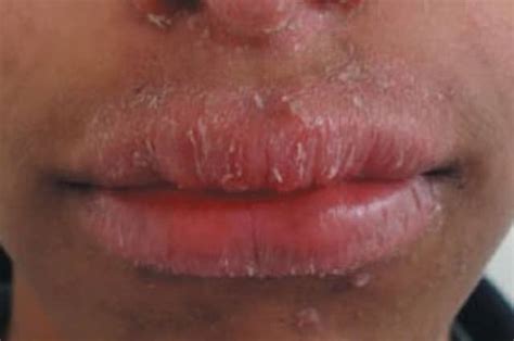 Dry Patches On Lip Upper Lower Pictures Causes Not Cold Sore