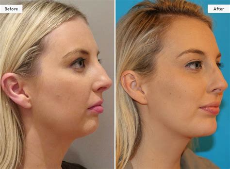 Chin Crease Filler Gallery Face To Face