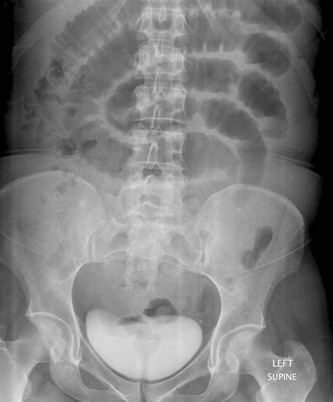 Condition Specific Radiology Small Bowel Obstruction Stepwards