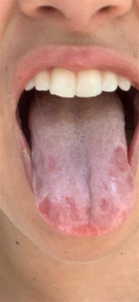 weird spots on tongue and burns like i ate something spicy but i didn t just noticed this