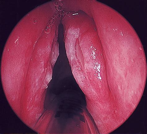 Leukoplakia is a firmly attached white patch on a mucous membrane which is associated with increased risk of cancer. Leukplakia of the True Vocal Cords