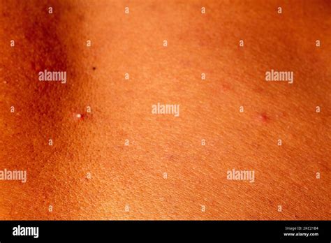 Human Skin Texture Wart And Pimples On Skin Micro Photo Close Up