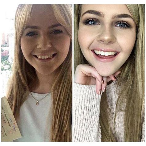 114 Incredible Before After Transformations Of People Who Wore Braces
