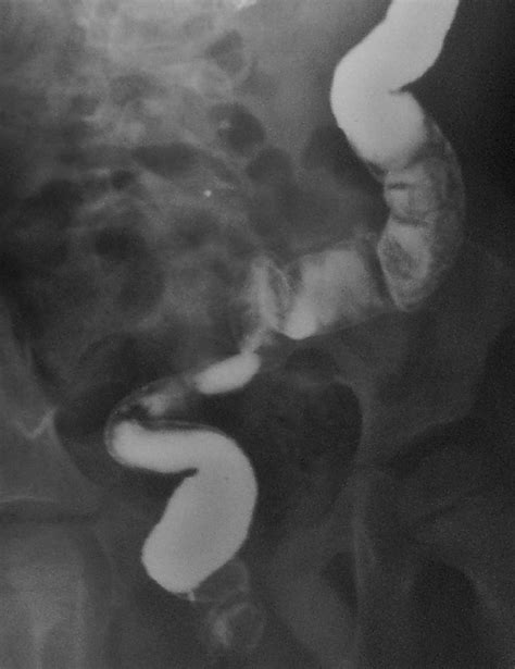 Barium Enema Film Showing Normal Passage Of Contrast Through Rectum Download Scientific