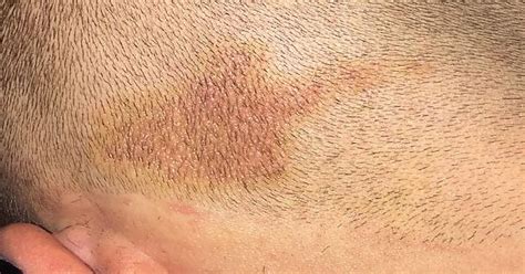 What Is This Rash On My Scalp Imgur