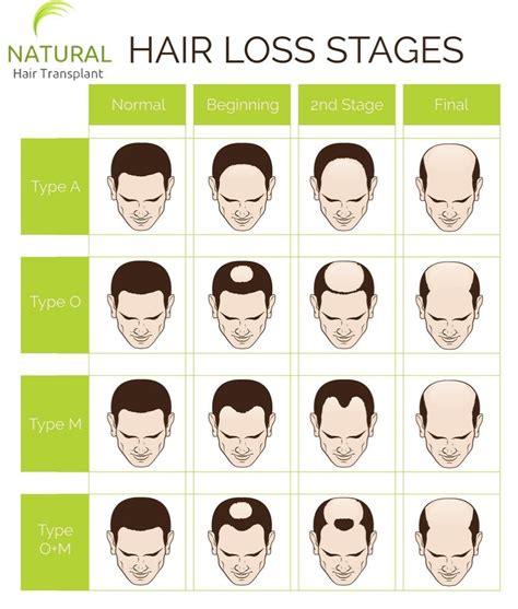 Stages Of Hair Loss Mens Hair Loss Treatment Mens Hair Loss Remedies