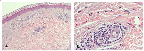 Histology Of The Skin Biopsy A There Is A Light Perivascular