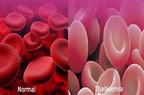 Thalassemia Beta Mayor Patofisiologis Dan Penyebab