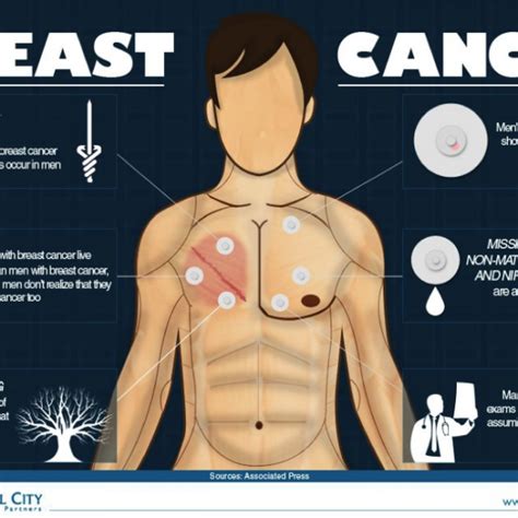 Male Breast Cancer Symptoms Bloemfontein Courant