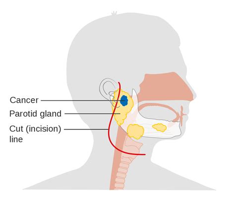 Oral Cancer Diagram