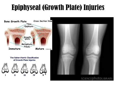 The Role Of The Epiphyseal Growth Plate In Bone Longitudinal Growth