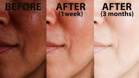 How To Reduce Acne Scars Discoloration Uneven Skin Tone Home