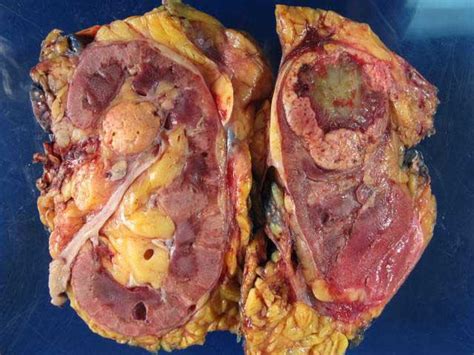 Department of health and human services food and drug. Personalized Medicine Brightens Outlook for Most Common Kidney Cancer - U.S. Medicine