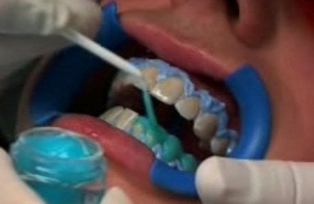 Produk gigi whitening gel di alibaba.com biasanya melibatkan pengaplikasian gel pemutih, baik yang ditahan dengan memakai baki yang pas. Seputar Memutihkan Gigi (Tooth Bleaching | Tooth Whitening ...