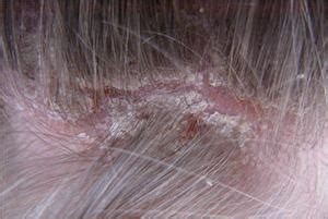 Treatments for Scalp Psoriasis | Scalp Dermatitis ...