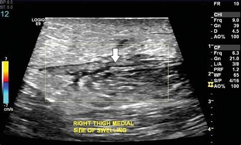 Ultrasound Scan Of The Right Thigh Swelling Showing Hypoechoic Area Of