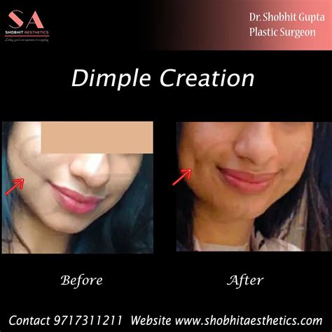 Dimple Surgery Cost Dimple Creation Surgery In Delhi Dr Shobhit Gupta