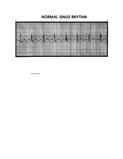 Sinus Bradycardia Cardiac Impairment