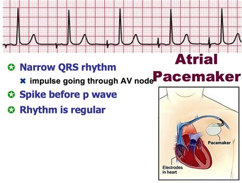 atrial pacing vs ventricular pacemaker my xxx hot girl