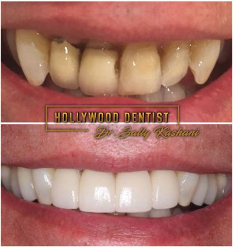Hollywood Dentist Before After Photos of Cosmetic Dental ...