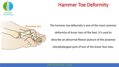 Hammer Toe Deformity OrthoFixar 2023