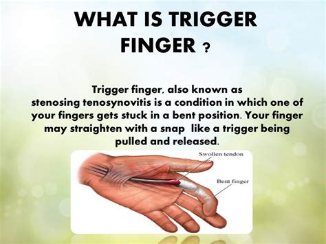 Diagram Diagram Of Trigger Finger Mydiagramonline