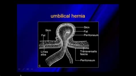 Umbilical Hernia On Ultrasound