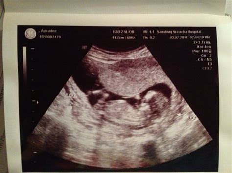 Can You See Anything Boy Or Girl At 14 Weeks Ultrasound Babycenter