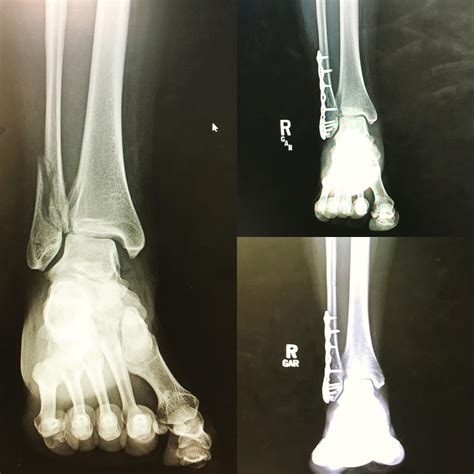 Xray Of Broken Ankle