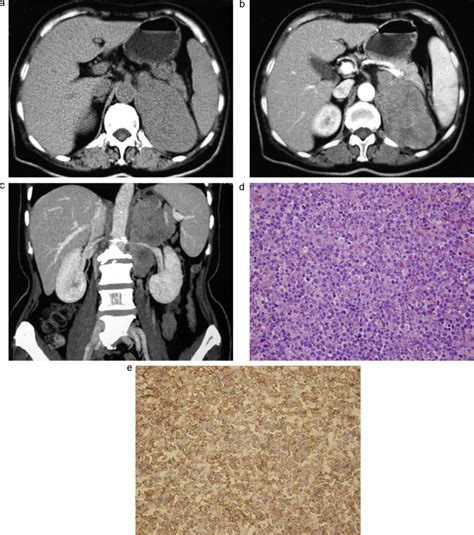 Primary Adrenal Lymphoma Radiological Pathological Clinical