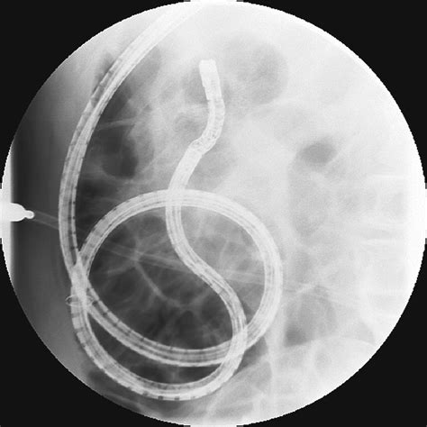 Therapeutic Ercp With The Double Balloon Enteroscope In Patients With