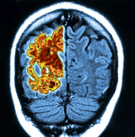 Doctors say that those who find the camel will be far from developing. Alzheimer's BREAKTHROUGH: Revolutionary treatment could ...