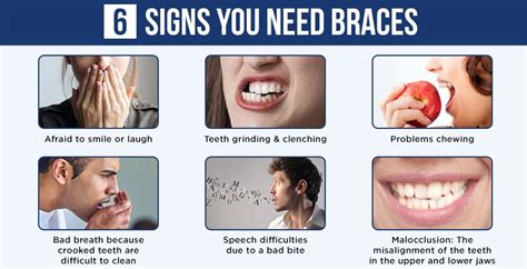 Signs You Need Braces