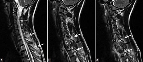 Radiological Imaging Findings Of A Case With Vertebral Osteoid Osteoma