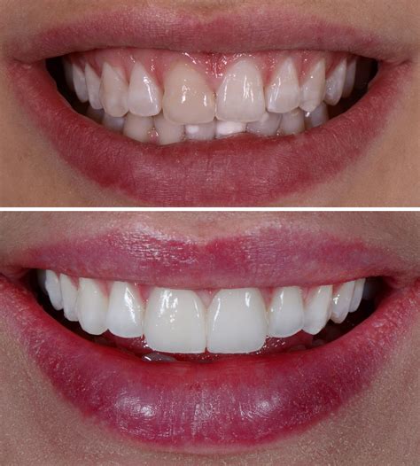 It's amazing how two teeth can make the biggest difference to your