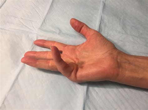 Pictures Of Dupuytrens Disease Hands John Erickson Md