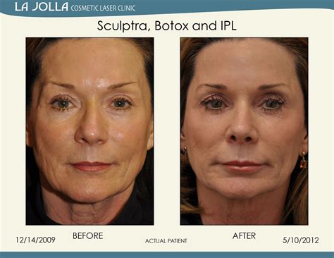 Patient Treated With Sculptra Botox And Ipl At La Jolla Cosmetic Laser