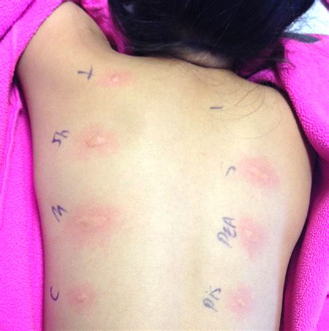 Food allergy tests help diagnose a specific allergy. FOOD ALLERGY TESTING: HOW TO FIND OUT WHAT YOU ARE ...