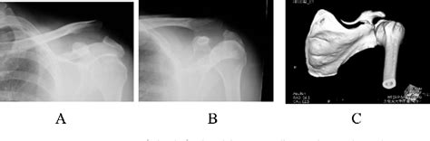 Figure 1 From A Case Of Acromioclavicular Joint Dislocation Associated